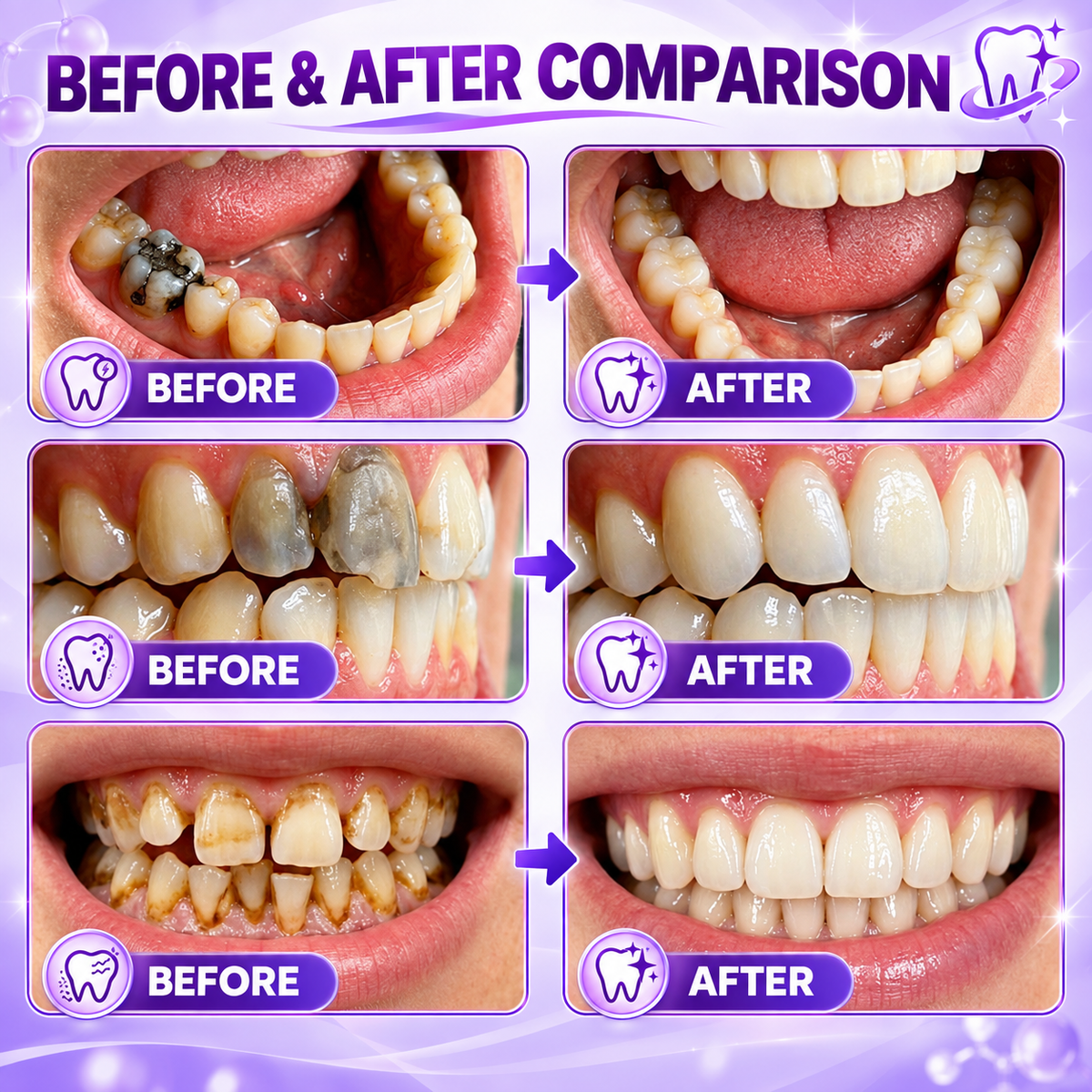 TERVENCE® DenPerm Cavity-Repair Natural Enamel Filling Gel