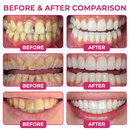 🇺🇸Aerissmile® DenPerm Cavity-Repair Natural Enamel Filling Gel
