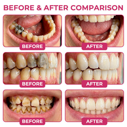 🇺🇸Aerissmile® DenPerm Cavity-Repair Natural Enamel Filling Gel